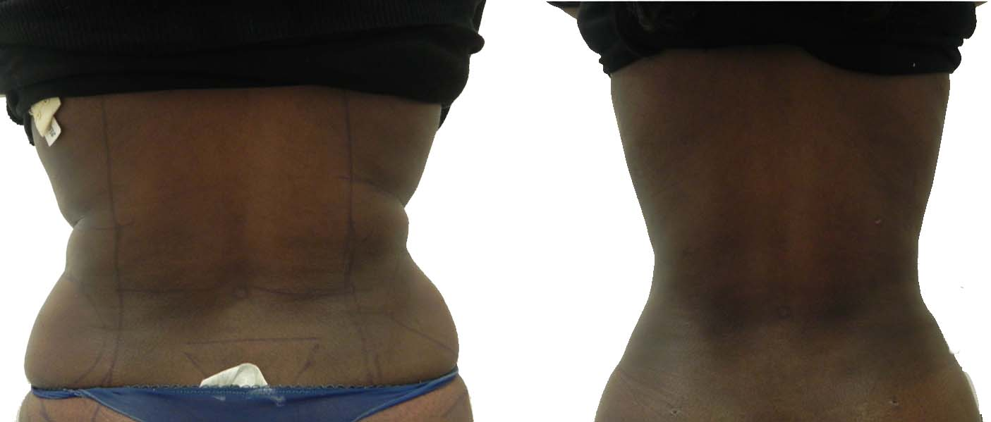 LIPOASPIRACAO LASER – Extensão Médica